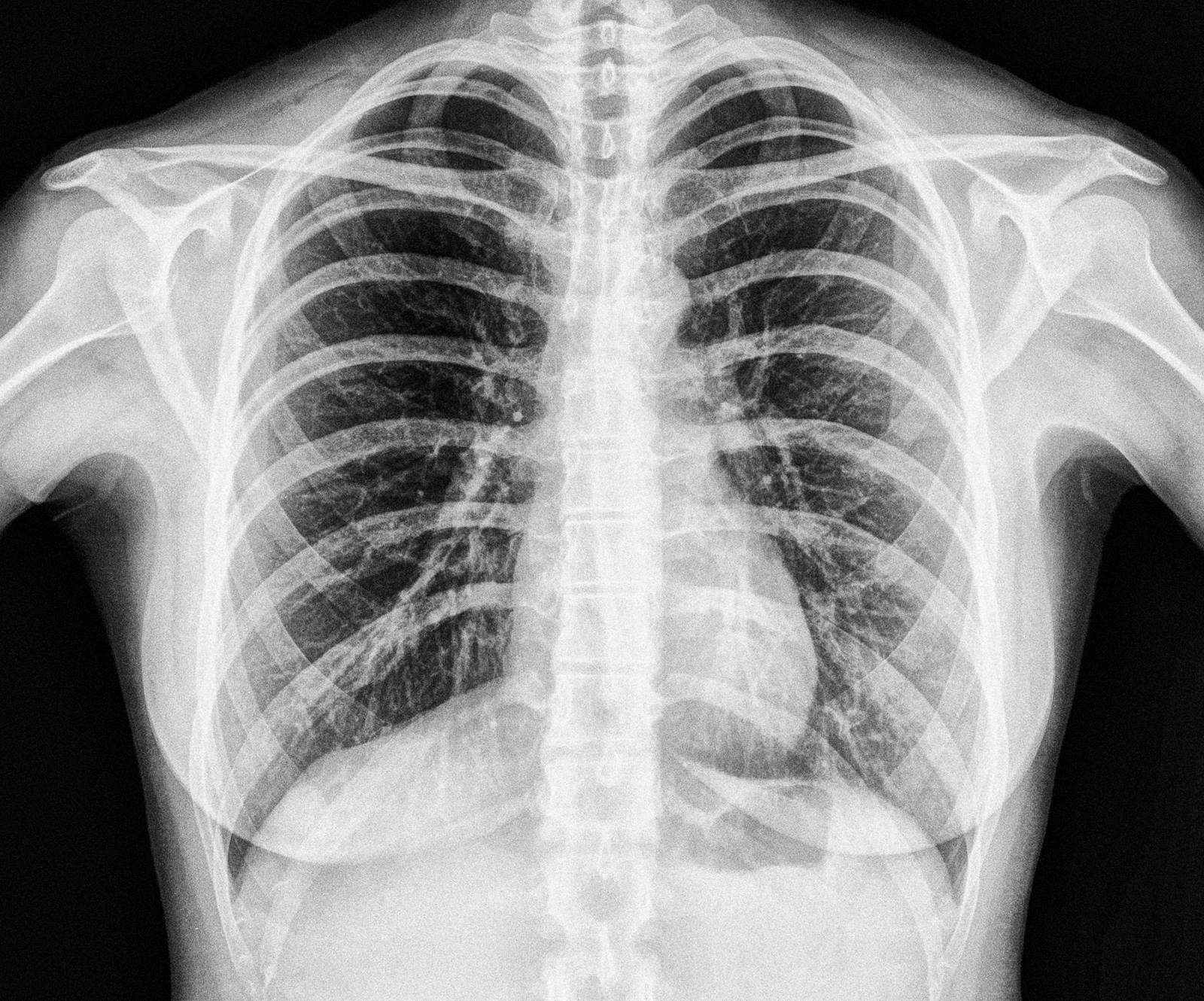 Флюорография легких. Рентген грудной клетки здорового человека. Рентгенография лёгких. Снимок грудной клетки здорового ребенка.